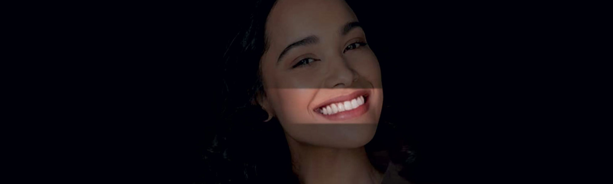 Zirneer - Stunning Veneers