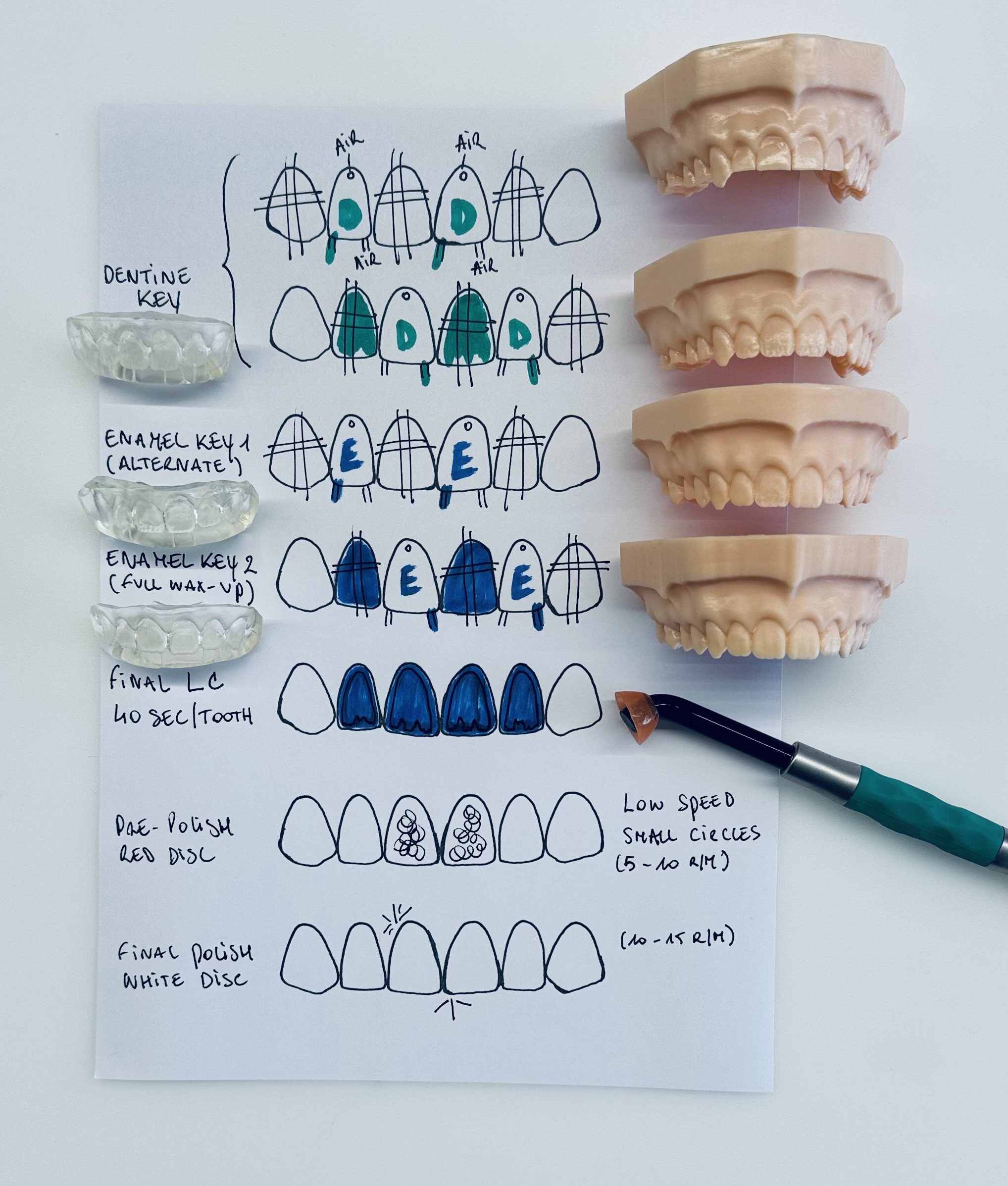 Forma® Injection Technique – Tooth Wear & Veneers - featured image