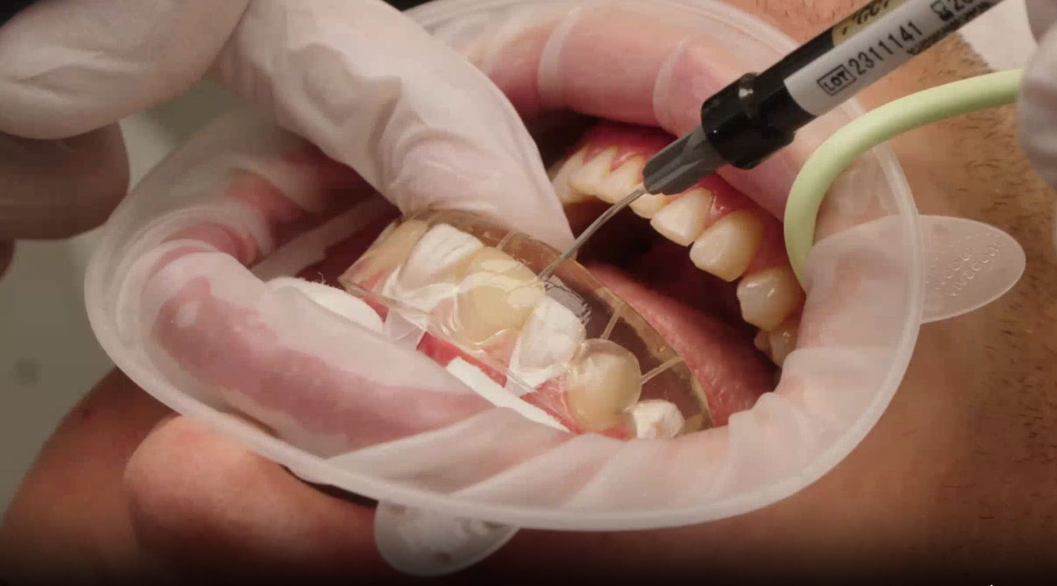Forma® Injection Technique – Tooth Wear & Veneers - featured image
