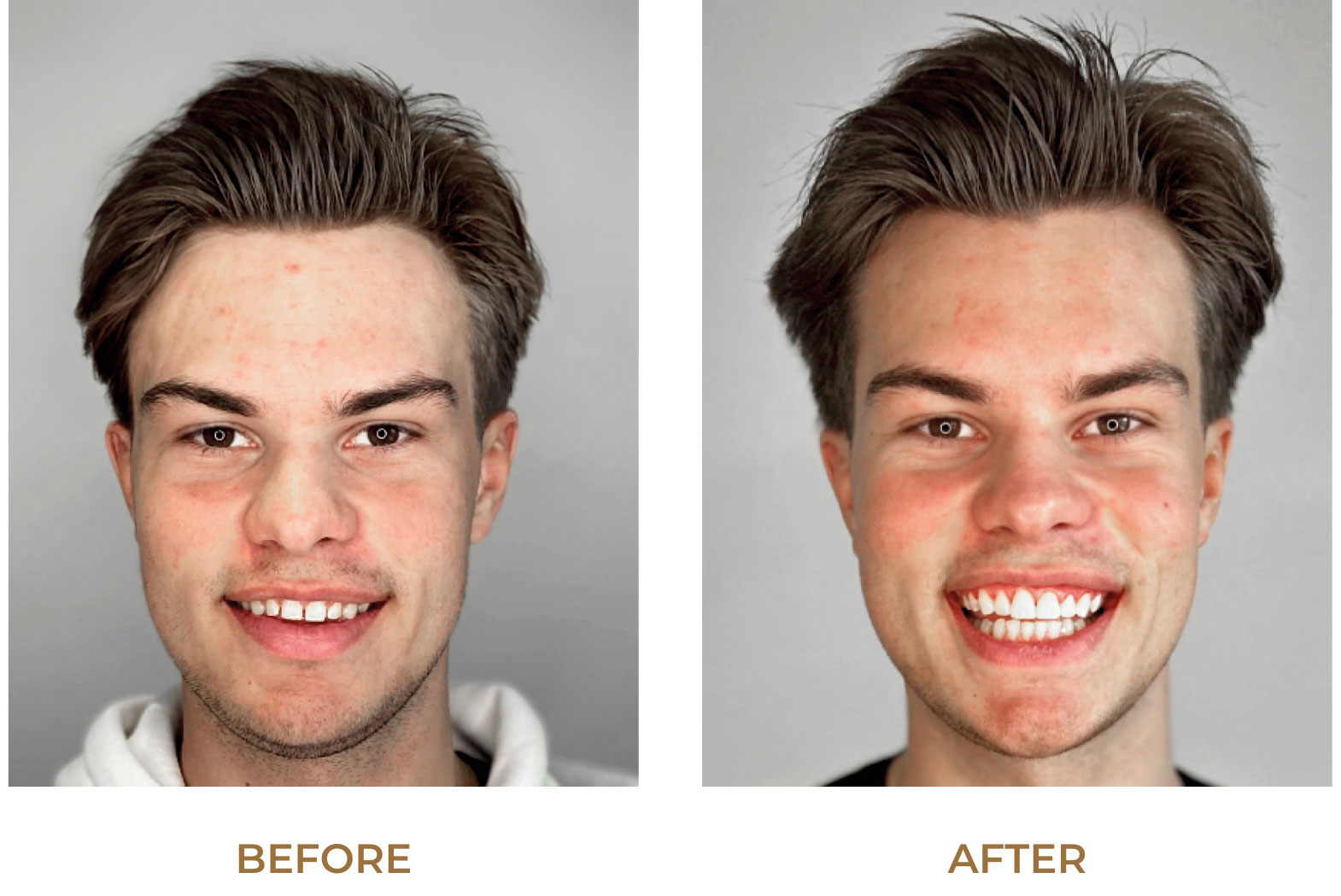 Before / After Composite Injection Technique