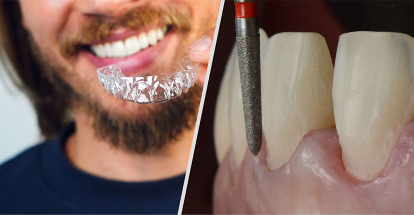 Pre-Restorative Alignment vs Tooth Preparation